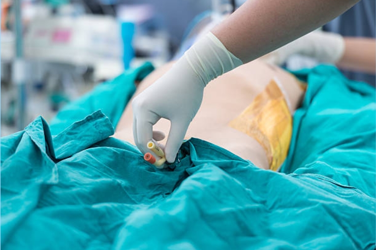 Urinary Incontinence Surgery-------21